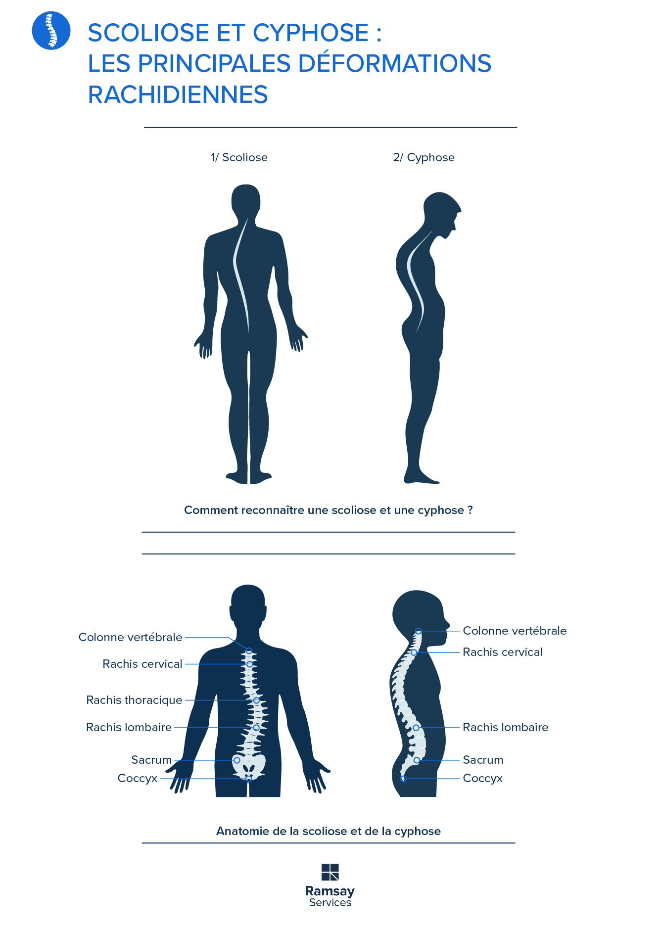 Scoliose et cyphose les principales déformations rachidiennes Scoliose et cyphose les principales déformations rachidiennes